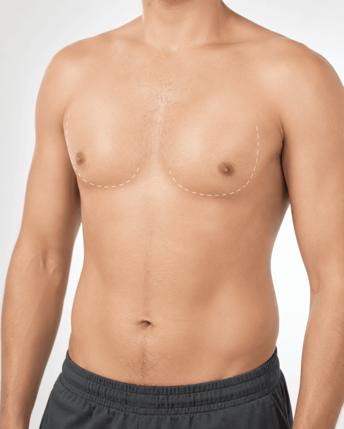 Gynecomastia consultation
